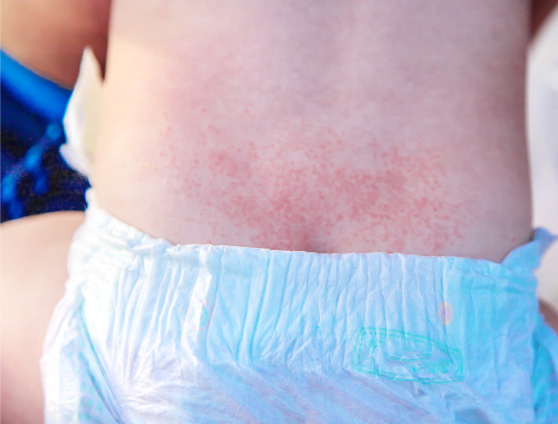 Skin with red patches shown on the back of a baby above it's diaper
